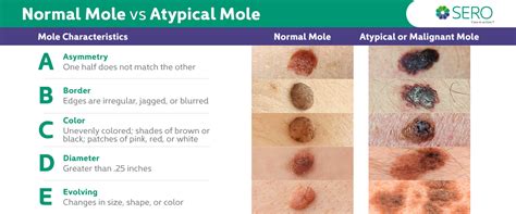 atypical mole not cancer